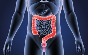 Colorectal Cancer