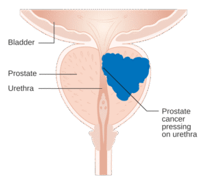 Prostate Cancer